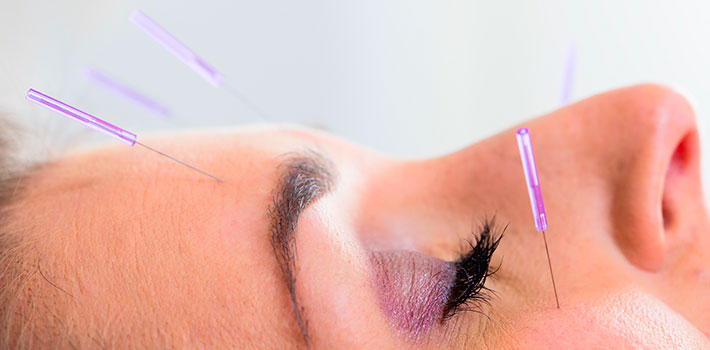 Acupuntura Lifting Facial Leire Piriz